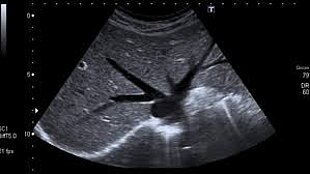 Bauchultraschall